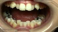 歯の治療映像　