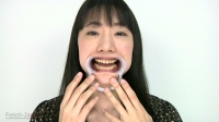 小室優奈さんの激烈処置歯