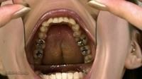 銀歯がいっぱい「歯」観察　写真データ14枚付属！