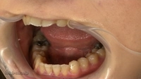 歯「リオナさん」の歯観察　画像データ９枚付
