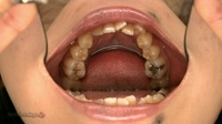 歯観察るりちゃんの「八重歯」