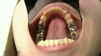 銀歯いっぱい　めいチャンの歯観察