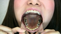 フェチ：優子の歯、観察「美しき銀歯」