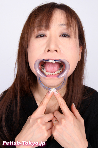 崩壊・銀歯・元歯科助手熟女さんの歯！