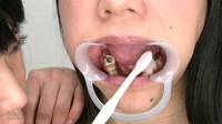 フェチ：ゆい＆優奈　処置歯をクリーニング